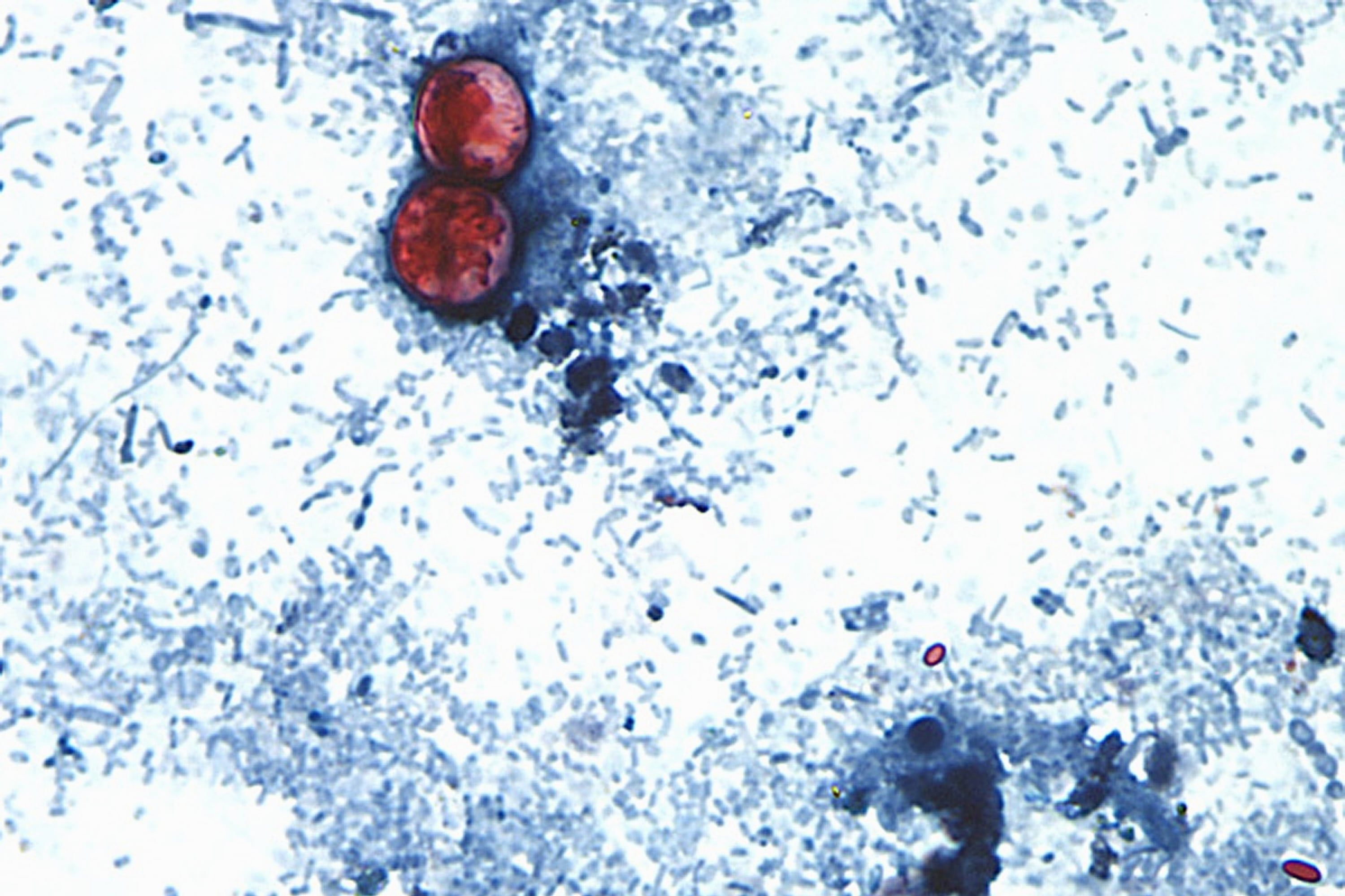 Cyclospora cayetanensis oocysts seen in a stool sample prepared with formalin solution and stained with safranin. - CDC via AP, File