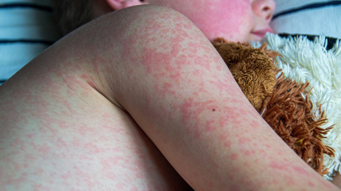 Measles rash on the body of a child. - Getty | Povorozniuk Liudmyla